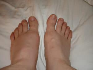 Gout swolen left foot